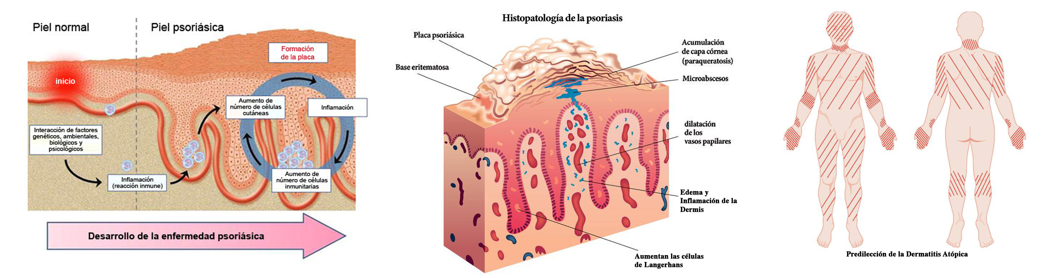 Psoriasis_y_dermatitis_atopica
